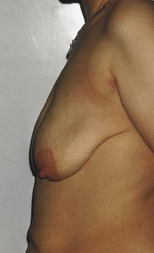 Podniesienie piersi - przed operacjÄ… Podniesienie piersi - przed operacjÄ…