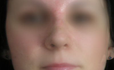 Po operacji Po operacji