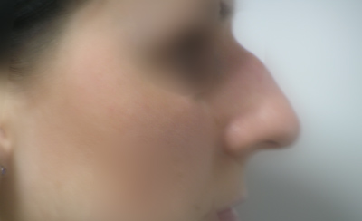 Przed operacjÄ… Przed operacjÄ…