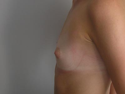 Powiększenie piersi - przed operacją Powiększenie piersi - przed operacją